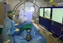 प्रीऑपरेटिव एम्बोलाइजेशन तकनीक से जटिल स्कल मेनिंजियोमा का सफल ऑपरेशन