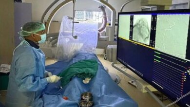 प्रीऑपरेटिव एम्बोलाइजेशन तकनीक से जटिल स्कल मेनिंजियोमा का सफल ऑपरेशन